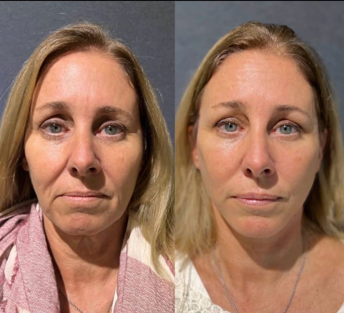 Skin treatment results at the Angel White Hove clinic