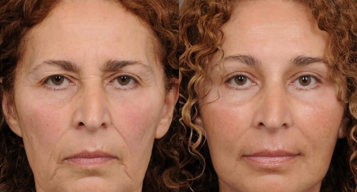 Face contouring before and after — restored cheek volume and defined jawline, Littlehampton
