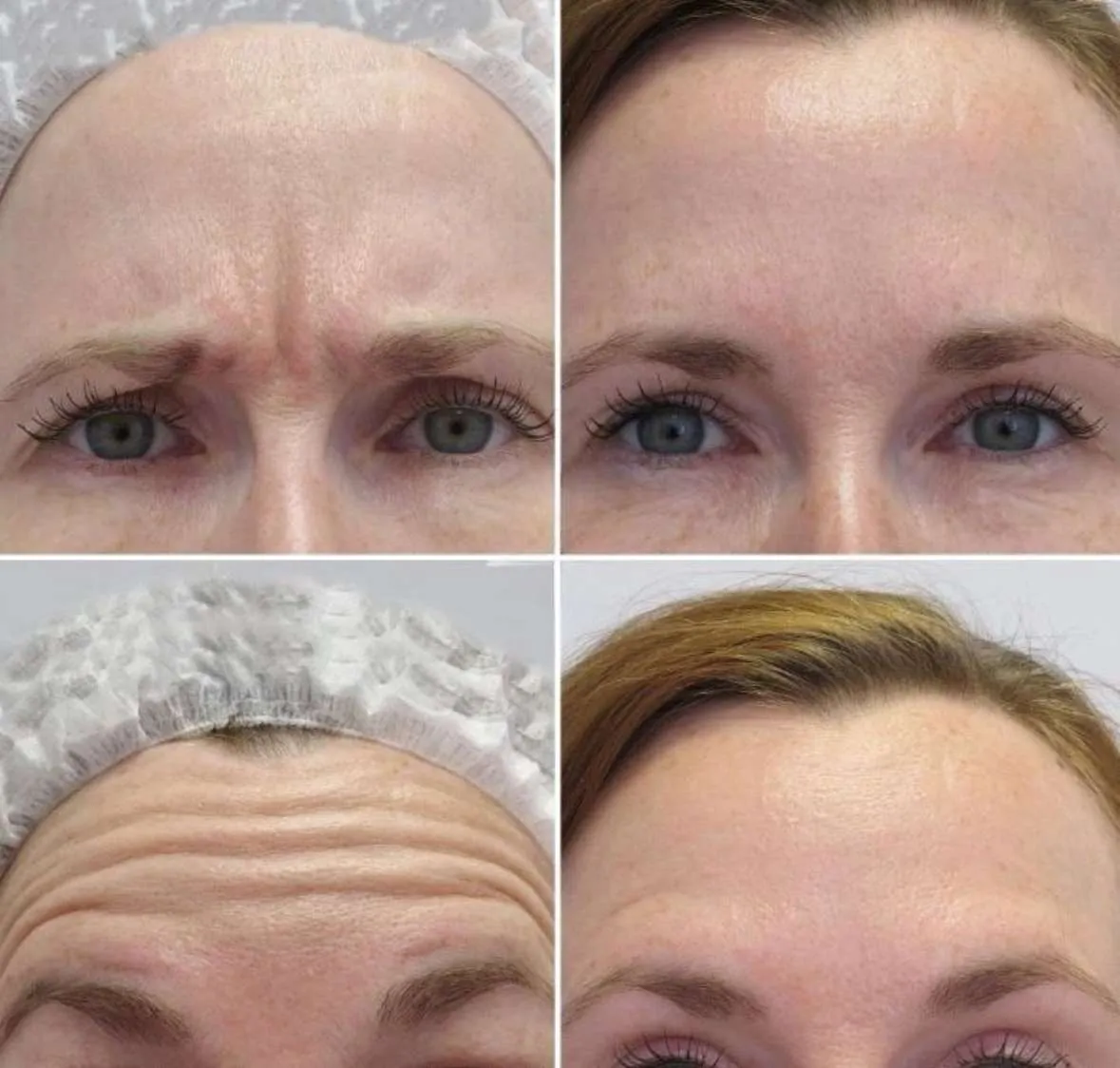 Anti-wrinkle treatment results for smoother lines and a refreshed look