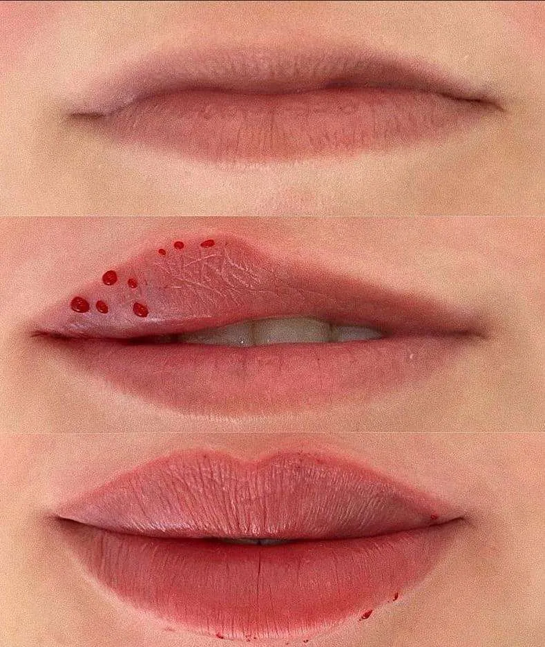 Lip filler treatment results