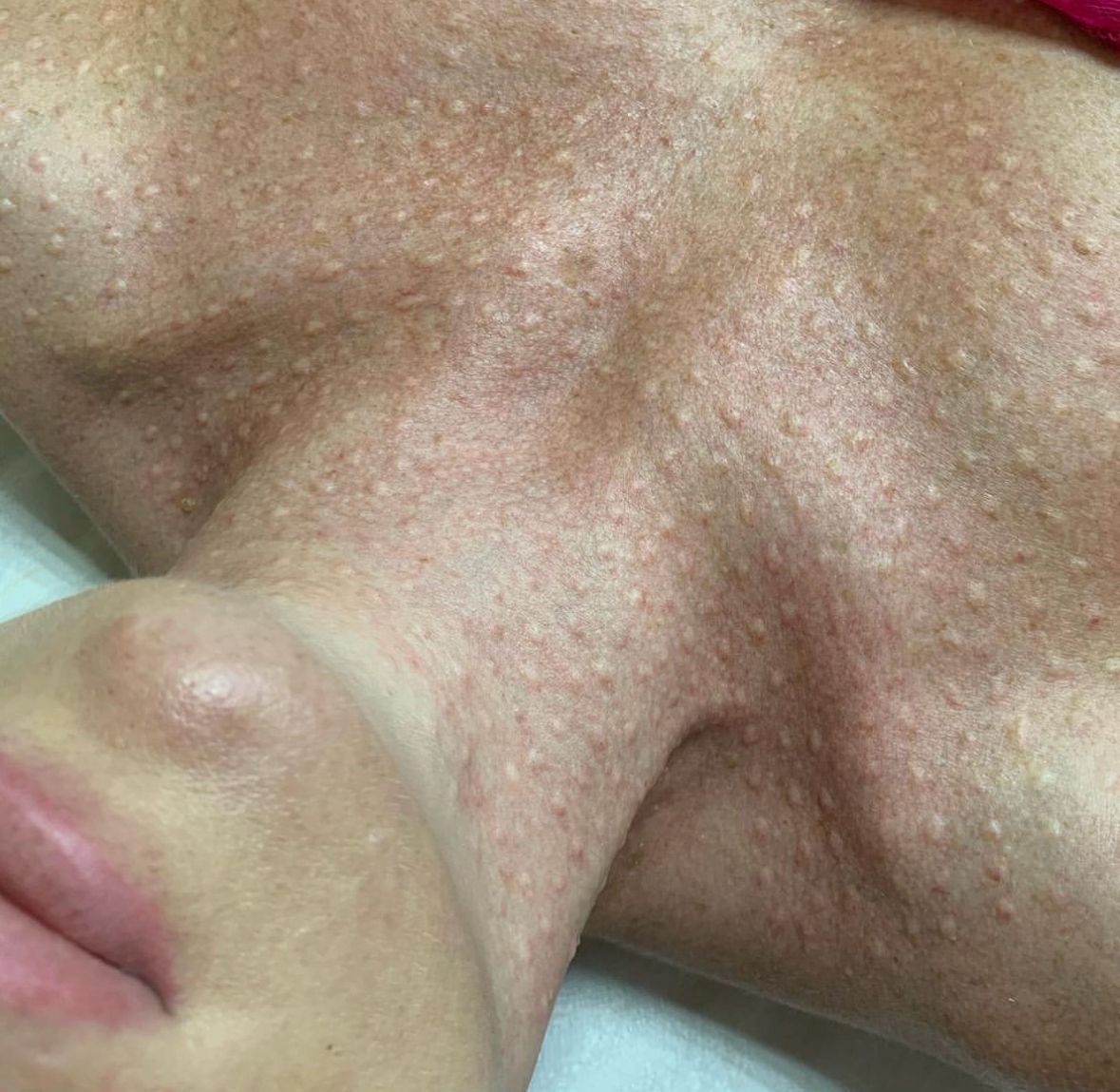 Skin treatment results to improve texture, tone and clarity