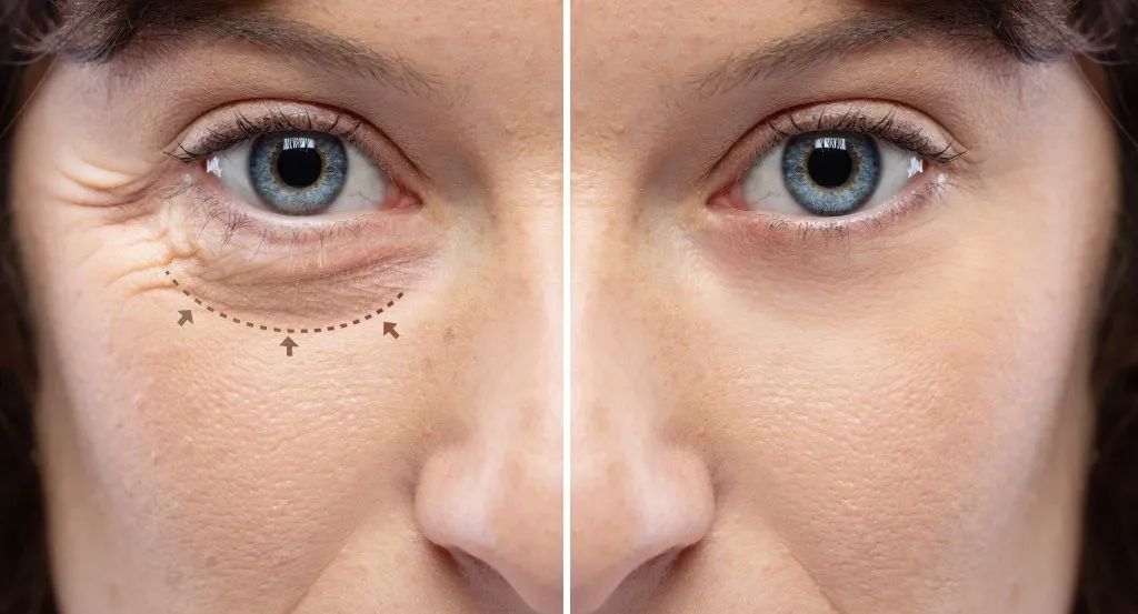Puffy eyes drainage treatment to reduce under-eye puffiness